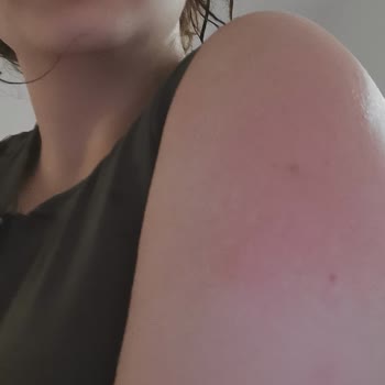 Trendyol Sipariş İ İle Yanık Olmak