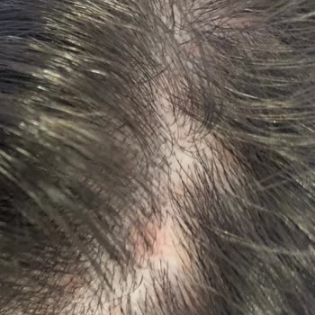 Hc Care Saç Serumu Saçlarımı Avuç Avuç Döküp Saç Dibimi Yara Yaptı.