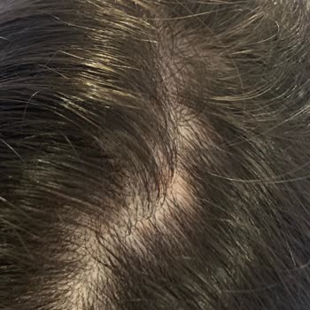 Hc Care Saç Serumu Saçlarımı Avuç Avuç Döküp Saç Dibimi Yara Yaptı.