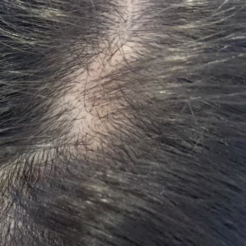 Hc Care Saç Serumu Saçlarımı Avuç Avuç Döküp Saç Dibimi Yara Yaptı.