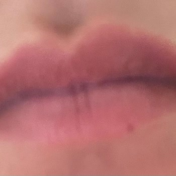 You Estetik Hizmetin Kötülüğü Ve Maddi Zarar