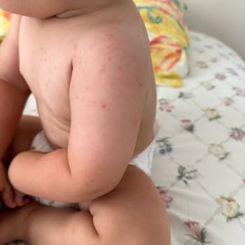 Mustela Güneş Kremi Alerjisi