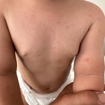 Mustela Güneş Kremi Alerjisi