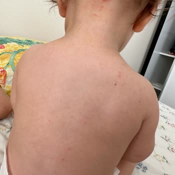 Mustela Güneş Kremi Alerjisi