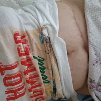 Sağlık Bakanlığı Yanlış Ameliyat U*** H*******