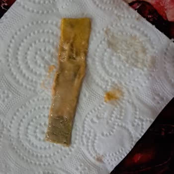 Özel Ekol Hastanesi (İzmir) Başarısız Burun Ameliyatı!