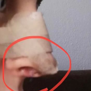 Özel Ekol Hastanesi (İzmir) Başarısız Burun Ameliyatı!