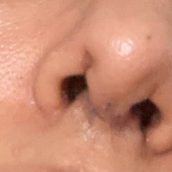 Özel Nev Hospital Burnuma Yanlış Kesikler Atılması