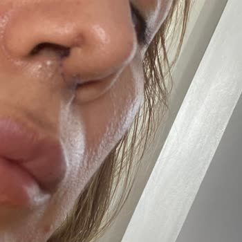 Özel Nev Hospital Burnuma Yanlış Kesikler Atılması