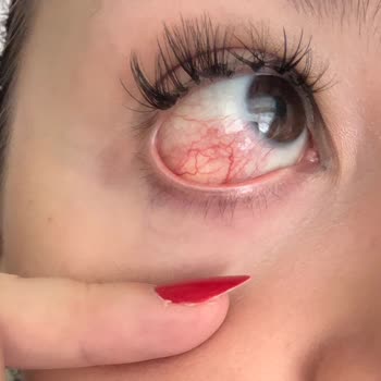 Rosse Moos Beauty İpek Kirpik Yaptırdım Ve Gözüm Enfeksiyon Kaptı.