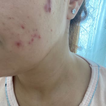 Bioderma Spot Yüzümde Büyük Büyük Sivilceler Çıkardı Mağdurum!