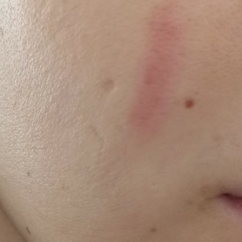 The Purest Solutions The Purest Tonik Yüzümde Leke Ve Yanma Yaptı