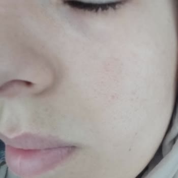 Estetika'da Yaptırdığım Dermapen