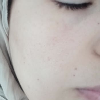 Estetika'da Yaptırdığım Dermapen
