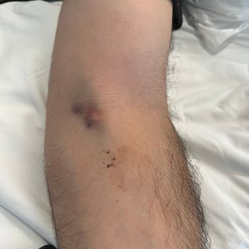 Memorial Hastanesi Hemşirelik Süreci Şikayeti