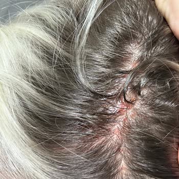 Crea Engin Kuaför Saçımı Ve Kafa Derimi Yaktılar