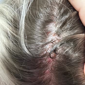 Crea Engin Kuaför Saçımı Ve Kafa Derimi Yaktılar