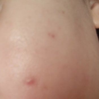 Flormar Stay Perfect Sivilceye Sebep Oldu