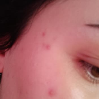 Flormar Stay Perfect Sivilceye Sebep Oldu