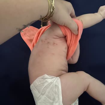 Aptamil 1 Alerji Yaptı 2 Aylık Bebeğim Çok Kötü Durumda