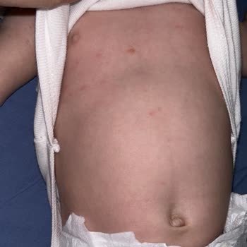 Aptamil 1 Alerji Yaptı 2 Aylık Bebeğim Çok Kötü Durumda