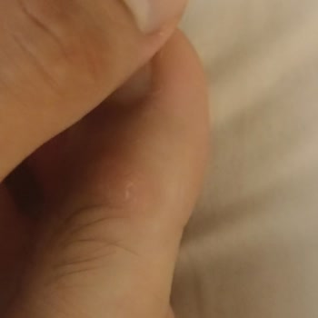 Deichmann Terlik Yüzünden Oluşan Yaralar