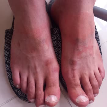 Gratis Ayak Maskesi Yanıklar Oluştu