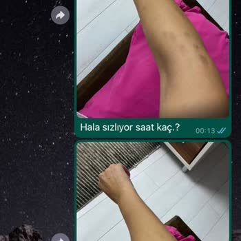 Anatolia Güzellik Merkezi Lazer Yanığı Ve Hizmet