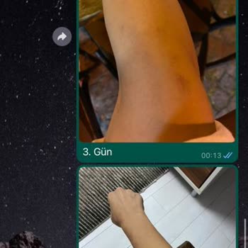 Anatolia Güzellik Merkezi Lazer Yanığı Ve Hizmet