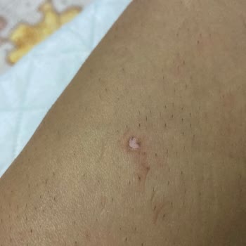 Beauty Boss Epilasyon Sonucu Yanık