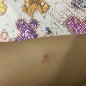 Beauty Boss Epilasyon Sonucu Yanık