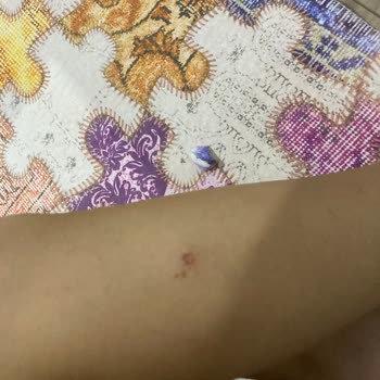 Beauty Boss Epilasyon Sonucu Yanık