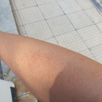 Bioder Tüy Dökücü Kremin Yaptığı Tahriş