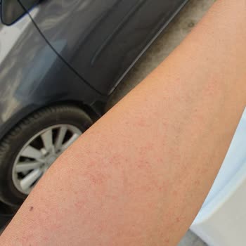 Bioder Tüy Dökücü Kremin Yaptığı Tahriş