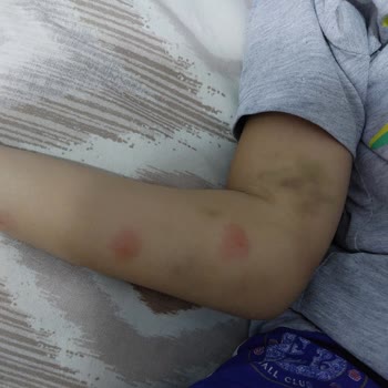 Acıbadem Hastanesi Diş Ameliyat Öncesi