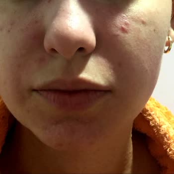 Yves Rocher Yüz Temizleme Jeli Alerji Yapıyor