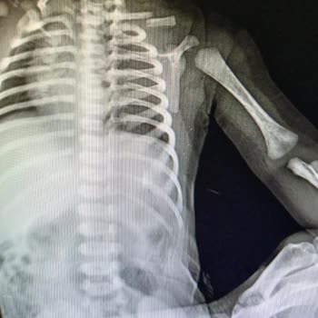 İstanbul Hospital Yeni Doğan Omuz Kırığı