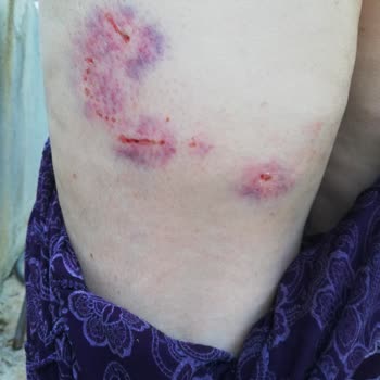 Antalya Muratpaşa Belediyesi Köpek Isırması Başımız Belada