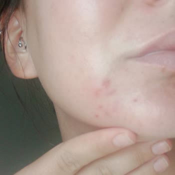 Yves Rocher Tonik Sivilce Yaptı