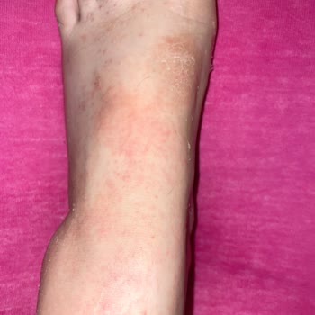 Gratis Ayak Peeling Maskesi Kullanımı Sonrası Ayaklarımın Durumu