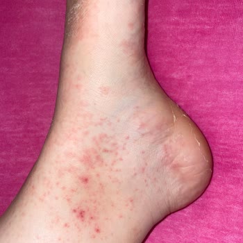 Gratis Ayak Peeling Maskesi Kullanımı Sonrası Ayaklarımın Durumu