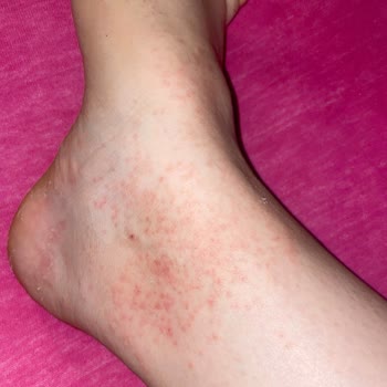 Gratis Ayak Peeling Maskesi Kullanımı Sonrası Ayaklarımın Durumu