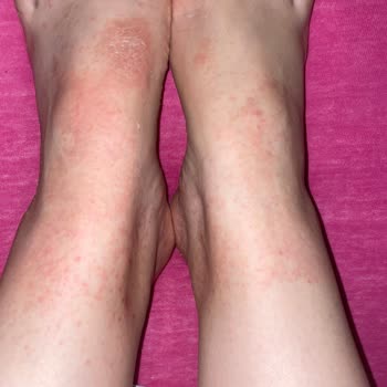 Gratis Ayak Peeling Maskesi Kullanımı Sonrası Ayaklarımın Durumu