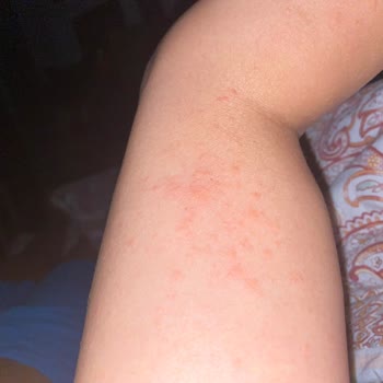 Eda Taşpınar Bronzlaştırıcı Yağ Vücudumda Kızarıklıklar Ve Kaşıntı