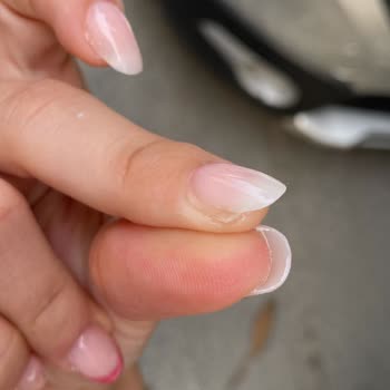 Aymira Koçaklı Yaşam Merkezi Özensiz Yapılmış Tırnak Ve Yanlış Çıkarma İşlemi