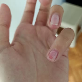 Aymira Koçaklı Yaşam Merkezi Özensiz Yapılmış Tırnak Ve Yanlış Çıkarma İşlemi