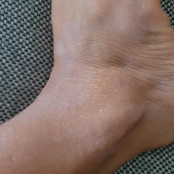 Eda Taşpınar Bronzlaştırıcı Alerji Yaptı