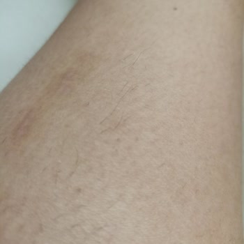 Neslim Güngen Güzellik Boşu Boşuna Lazer İşlemi