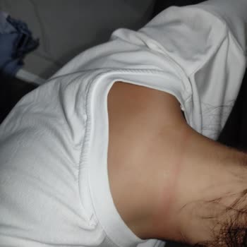 Nis Kuaför Saç Kesiminde Cildim Hasar Gördü