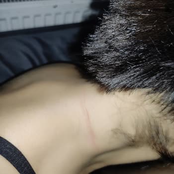 Nis Kuaför Saç Kesiminde Cildim Hasar Gördü